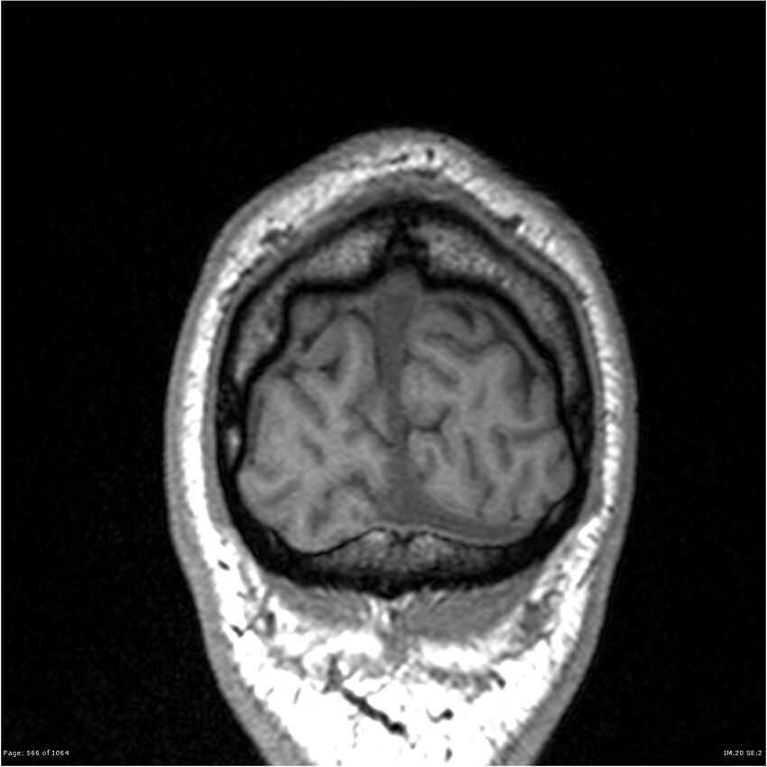 Normal brain MRI (non-focal epilepsy protocol) (Radiopaedia 38571-40700 Coronal T1 9).jpg