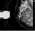 Normal breast ductogram (Radiopaedia 36440-37995 MLO 1).JPG