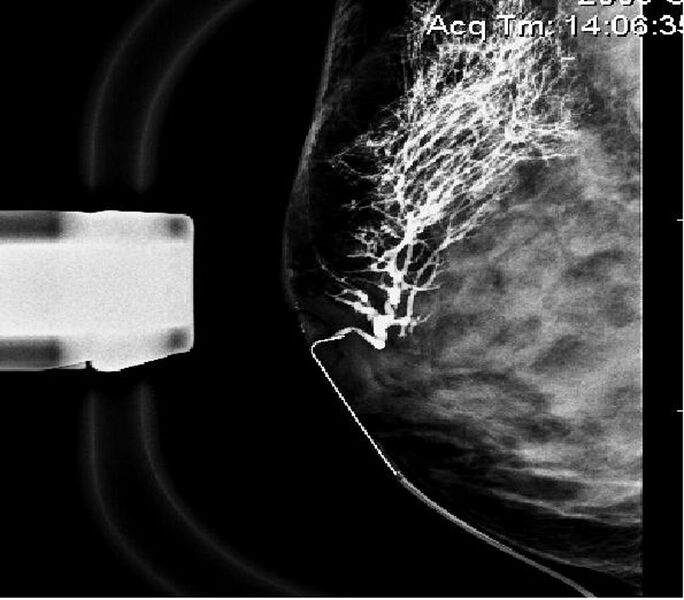 File:Normal breast ductogram (Radiopaedia 36440-37995 MLO 1).JPG