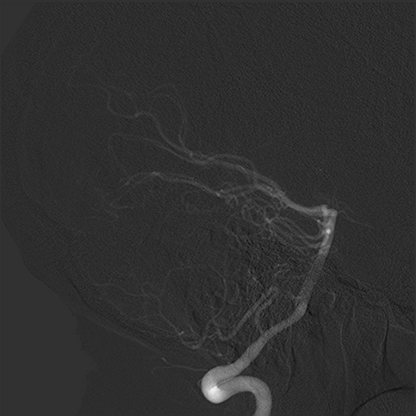File:Normal cerebral angiogram (four vessel DSA) (Radiopaedia 41708-44649 R 9).png