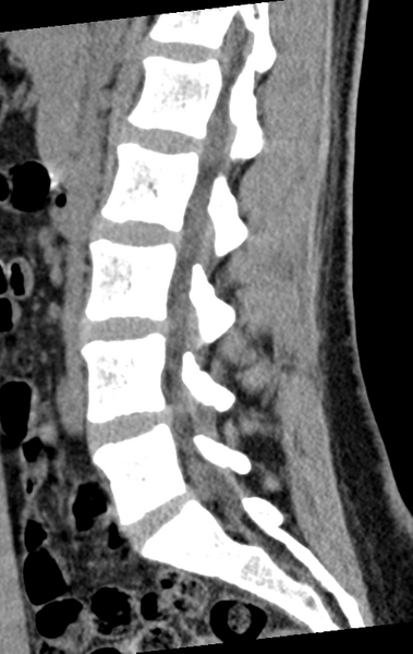 File:Normal lumbar spine CT (Radiopaedia 46533-50986 C 58).png