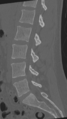 Normal lumbar spine CT (Radiopaedia 46533-50986 Sagittal bone window 57).png