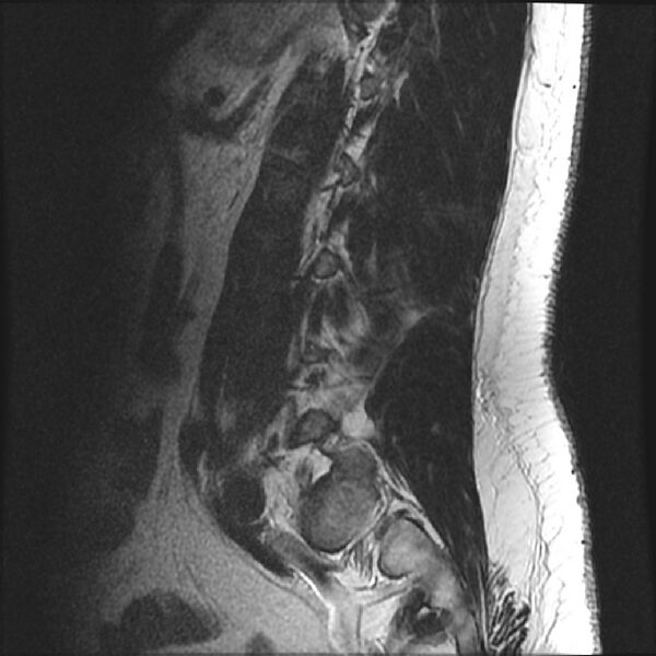 File:Normal lumbar spine MRI (Radiopaedia 43051-46311 Sagittal T2 4).jpg