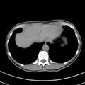 Normal multiphase CT liver (Radiopaedia 38026-39996 Axial non-contrast 7).jpg