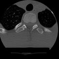 Normal trauma spine imaging (age 16) (Radiopaedia 45335-49358 Axial bone window 84).jpg