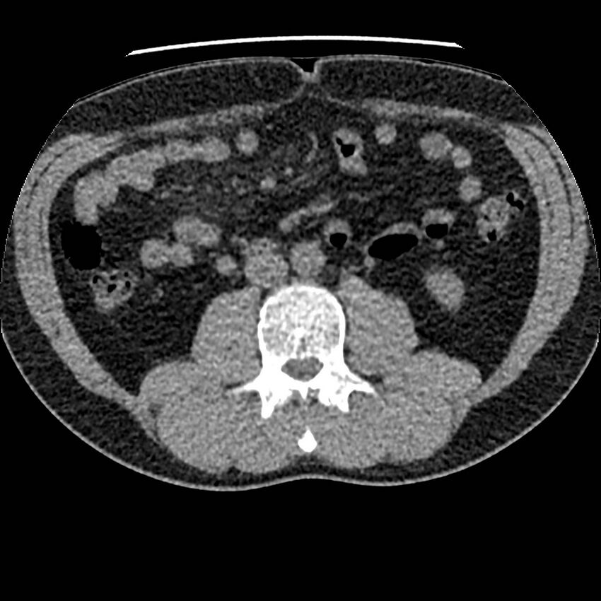 Obstructing ureteric calculus and ureteric anatomy (Radiopaedia 62730-71042 Axial non-contrast 65).jpg