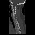 Occipital condyle fracture (Radiopaedia 31755-32691 Sagittal bone window 16).jpg