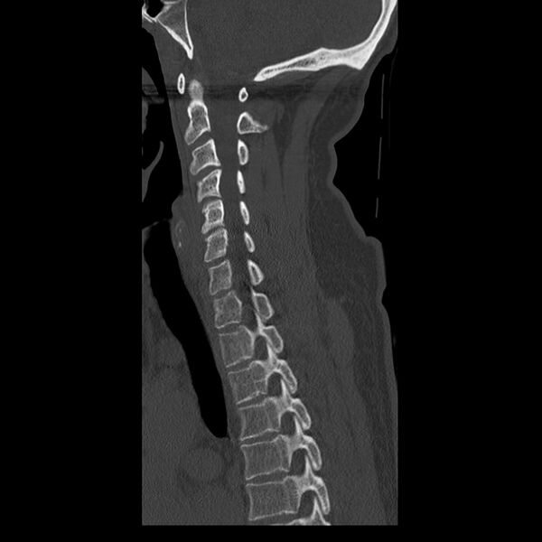 File:Occipital condyle fracture (Radiopaedia 31755-32691 Sagittal bone window 16).jpg
