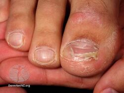 Onychomadesis following hand foot and mouth disease