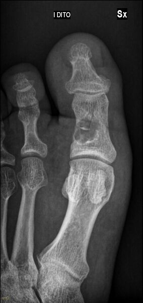 File:Unicameral bone cyst of the big toe (Radiopaedia 86812-102970 Frontal 1).jpg
