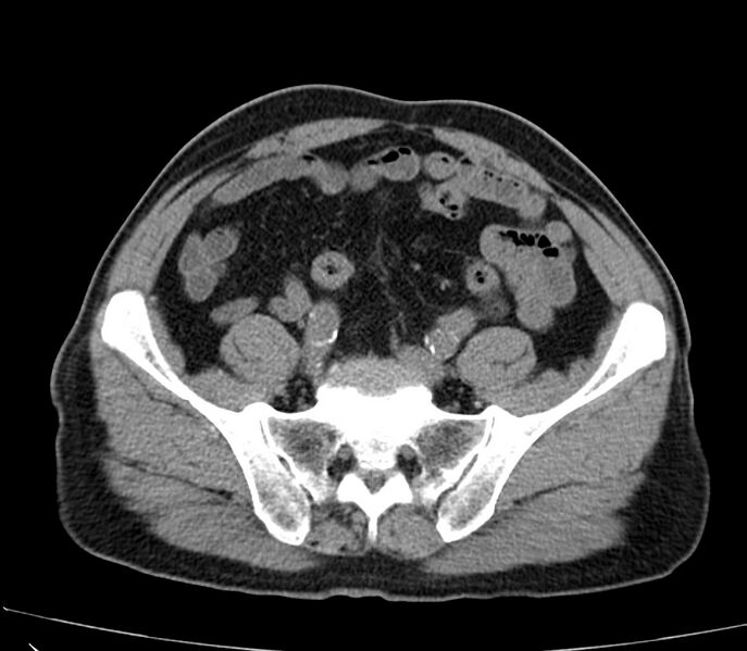 File:Abdominal aortic aneurysm (Radiopaedia 22421-22458 non-contrast 41).jpg