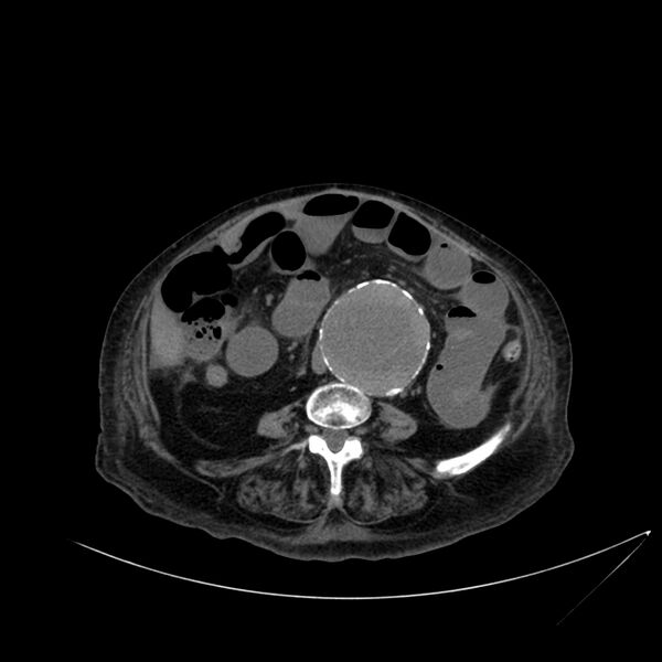 File:Abdominal aortic aneurysm - impending rupture (Radiopaedia 19233-19246 Axial non-contrast 75).jpg