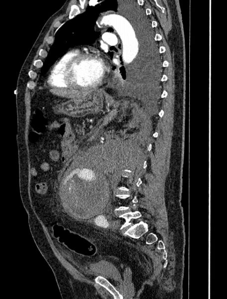 File:Abdominal aortic aneurysm rupture (Radiopaedia 54179-60362 Sagittal C+ arterial phase 26).jpg