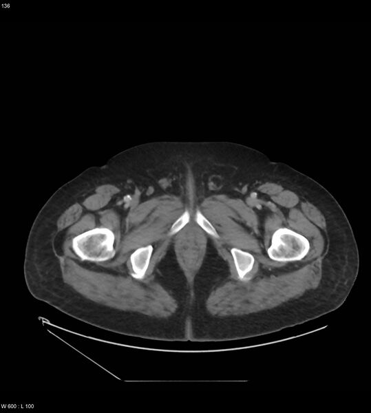 File:Abdominal aortic aneurysm with intramural hematoma then rupture (Radiopaedia 50278-55631 Axial C+ arterial phase 127).jpg