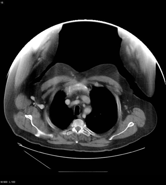File:Abdominal aortic aneurysm with intramural hematoma then rupture (Radiopaedia 50278-55631 Axial C+ arterial phase 9).jpg