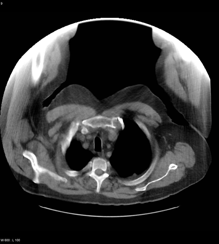 Abdominal aortic aneurysm with intramural hematoma then rupture (Radiopaedia 50278-55631 Axial non-contrast 5).jpg