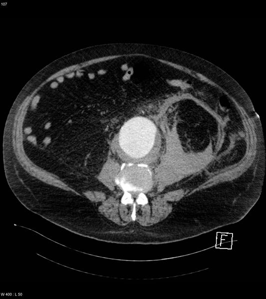 File:Abdominal aortic aneurysm with intramural hematoma then rupture (Radiopaedia 50278-55632 Axial C+ arterial phase 106).jpg
