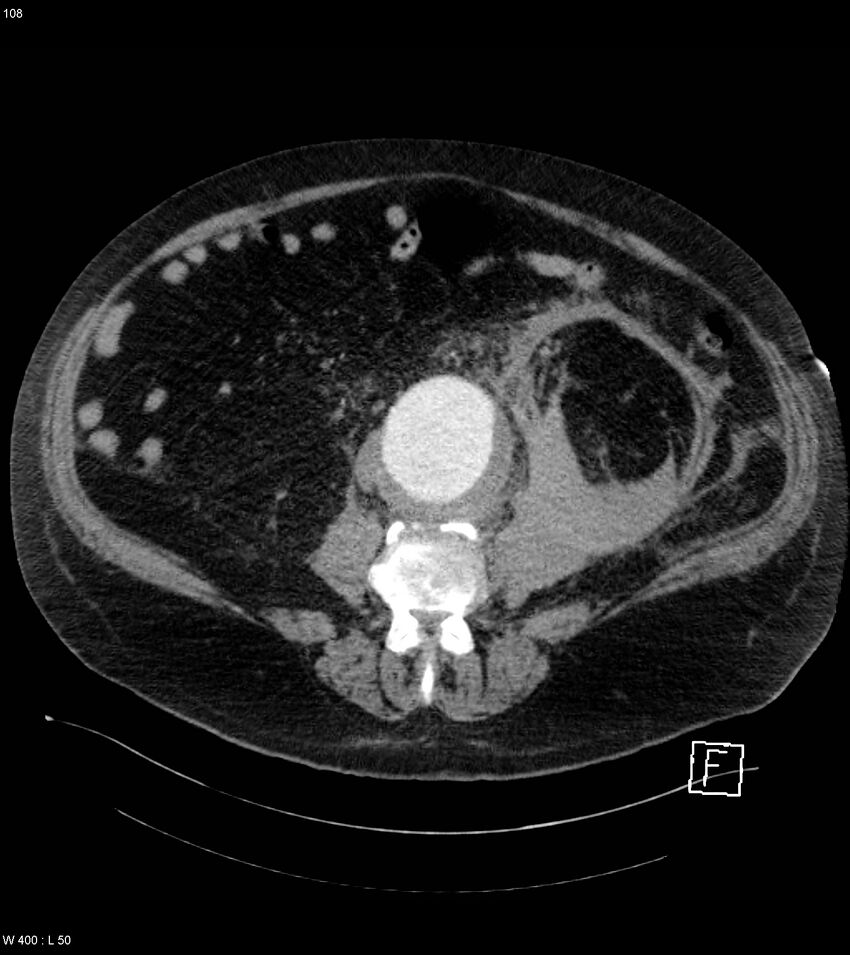 Abdominal aortic aneurysm with intramural hematoma then rupture (Radiopaedia 50278-55632 Axial C+ arterial phase 107).jpg