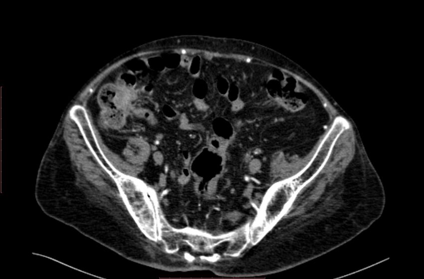 Abdominal aortic interposition tube graft and aneurysm thrombosis (Radiopaedia 71438-81857 Axial C+ arterial phase 176).jpg