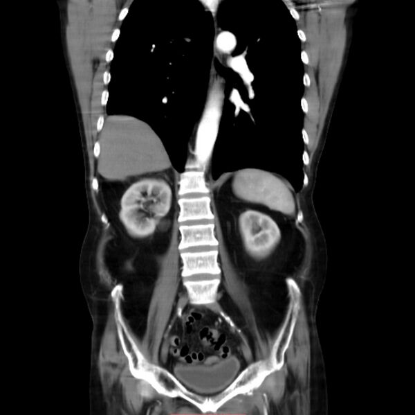 File:Abdominal aortic interposition tube graft and aneurysm thrombosis (Radiopaedia 71438-81857 Coronal C+ arterial phase 17).jpg