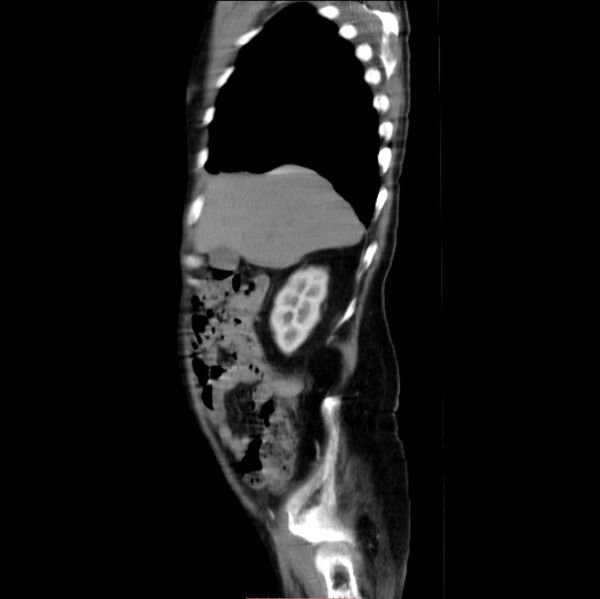 File:Abdominal aortic interposition tube graft and aneurysm thrombosis (Radiopaedia 71438-81857 Sagittal C+ arterial phase 28).jpg