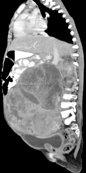 File:Abdominopelvic rhabdomyosarcoma (Radiopaedia 78356-90984 Sagittal C+ portal venous phase 51).jpg