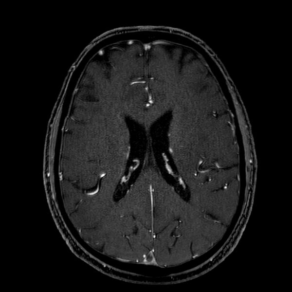 File:Accessory middle cerebral artery (Radiopaedia 73114-83828 Axial MRA 131).jpg