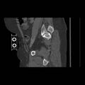 Acetabular fracture (Radiopaedia 13193-13212 Sagittal bone window 31).jpg