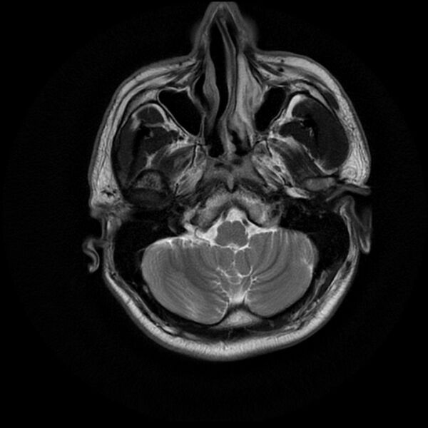 File:Acoustic schwannoma - intracanalicular (Radiopaedia 37247-39024 Axial T2 4).jpg