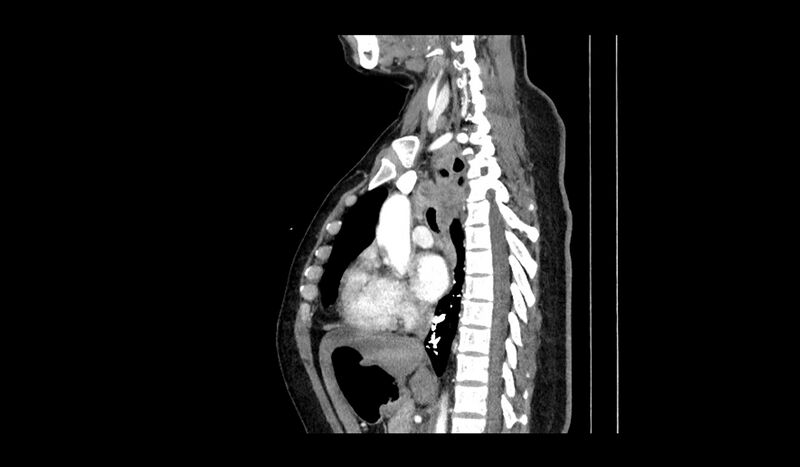 File:Acquired tracheo-esophageal fistula (Radiopaedia 51356-57103 Sagittal C+ arterial phase 8).jpg
