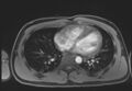 Active right ventricular cardiac sarcoidosis (Radiopaedia 55596-62100 Axial Post contrast Dixon 47).jpg