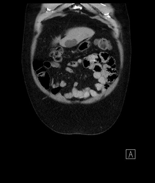 File:Acute-on-chronic pancreatitis (Radiopaedia 67286-76656 Coronal C+ portal venous phase 17).jpg