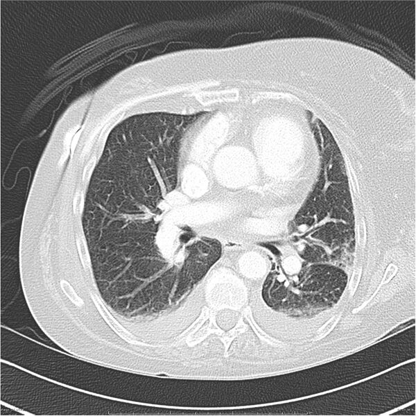 File:Acute-on-chronic pulmonary emboli (Radiopaedia 27925-28169 lung window 25).jpg
