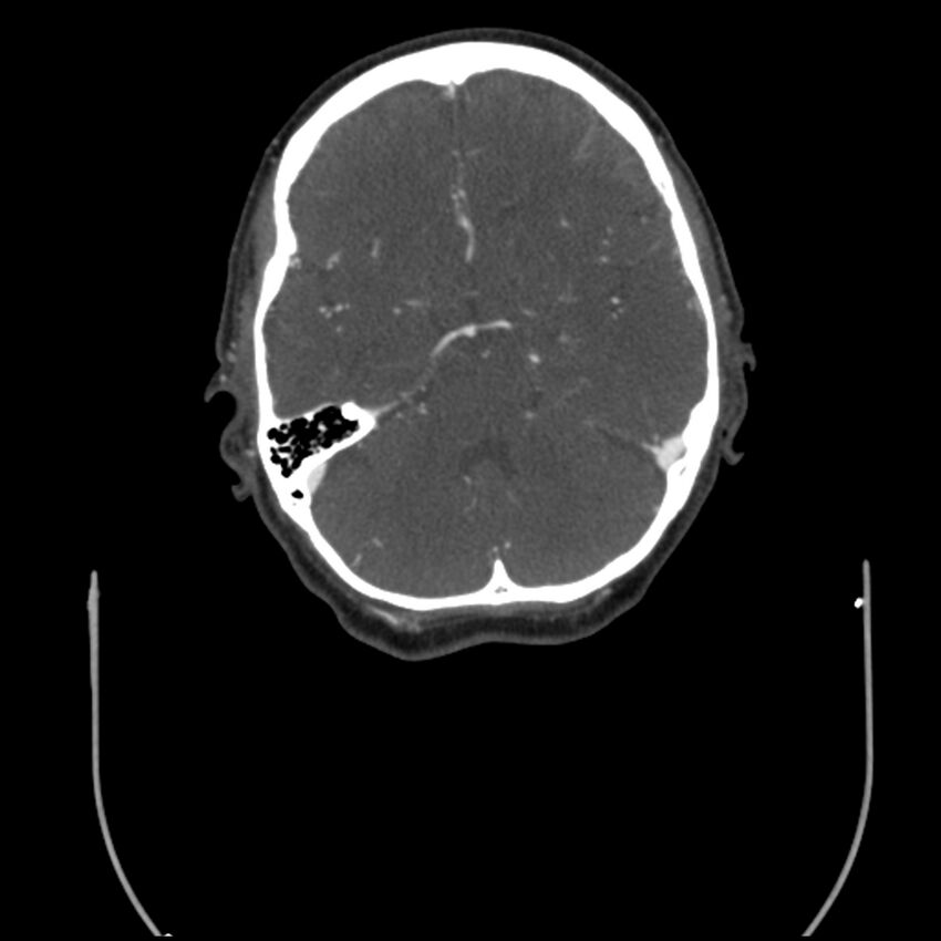 Acute M1 occlusion with ischemic penumbra (CT perfusion) (Radiopaedia 71897-82344 Axial C+ arterial phase thins 85).jpg