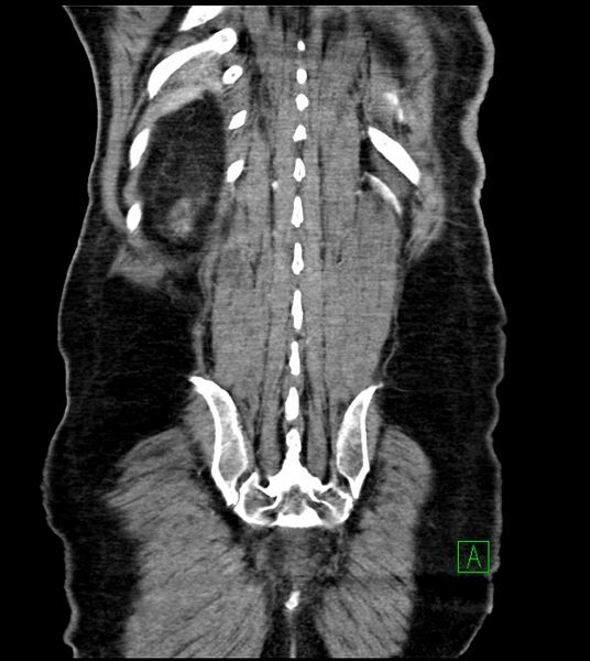 File:Acute arterial mesenteric ischemia (Radiopaedia 78238-90828 Coronal C+ portal venous phase 78).jpg