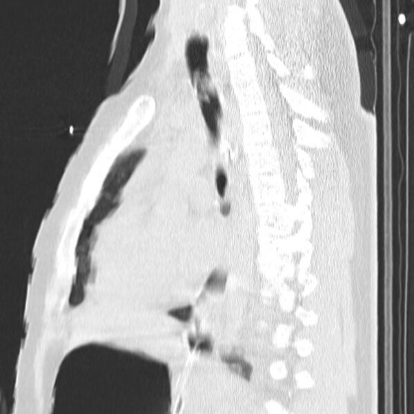 File:Acute aspiration pneumonitis (Radiopaedia 33605-34703 Sagittal lung window 48).jpg