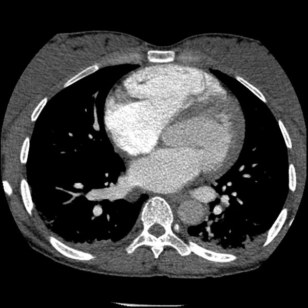 File:Acute chest syndrome - sickle cell disease (Radiopaedia 42375-45499 Axial C+ CTPA 111).jpg
