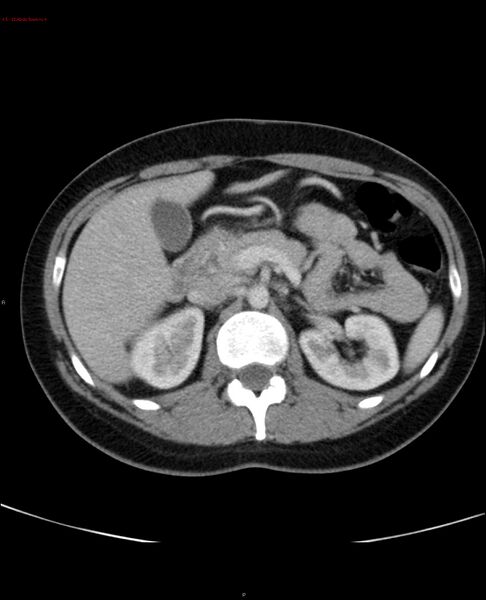 File:Acute gastritis (Radiopaedia 21043-20975 Axial C+ portal venous phase 18).jpg