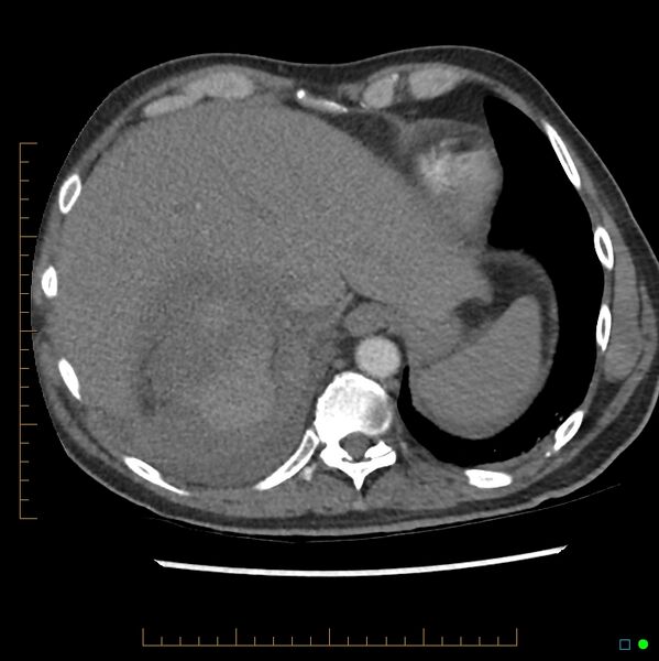 File:Acute hemorrhage into adrenal metastasis from NSCLC (Radiopaedia 43135-46429 Axial C+ CTPA 7).jpg