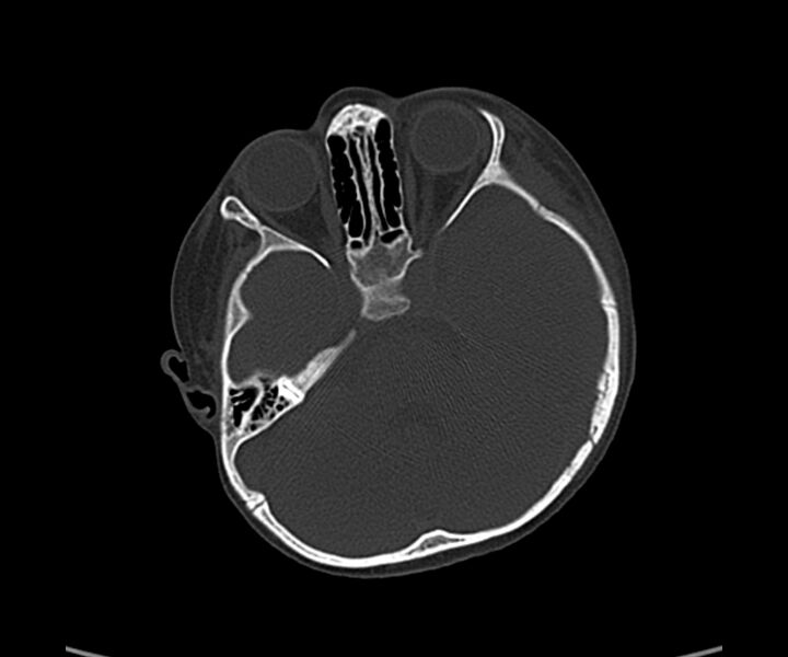 File:Acute hemorrhagic contusion (Radiopaedia 63660-72336 Axial bone window 21).jpg