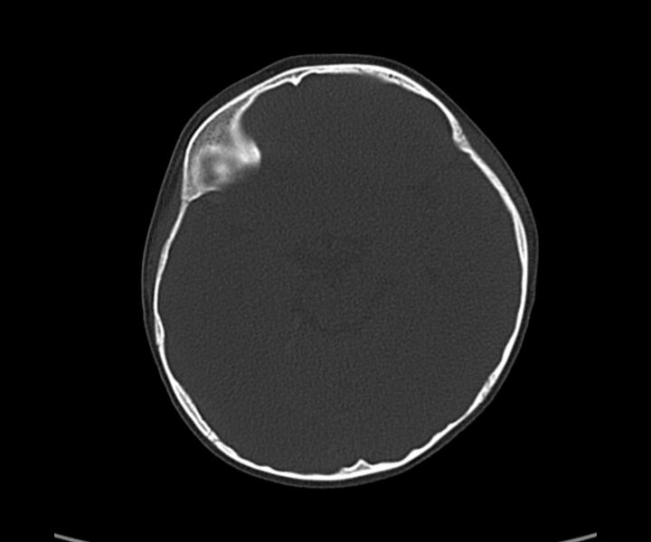 File:Acute hemorrhagic contusion (Radiopaedia 63660-72336 Axial bone window 28).jpg