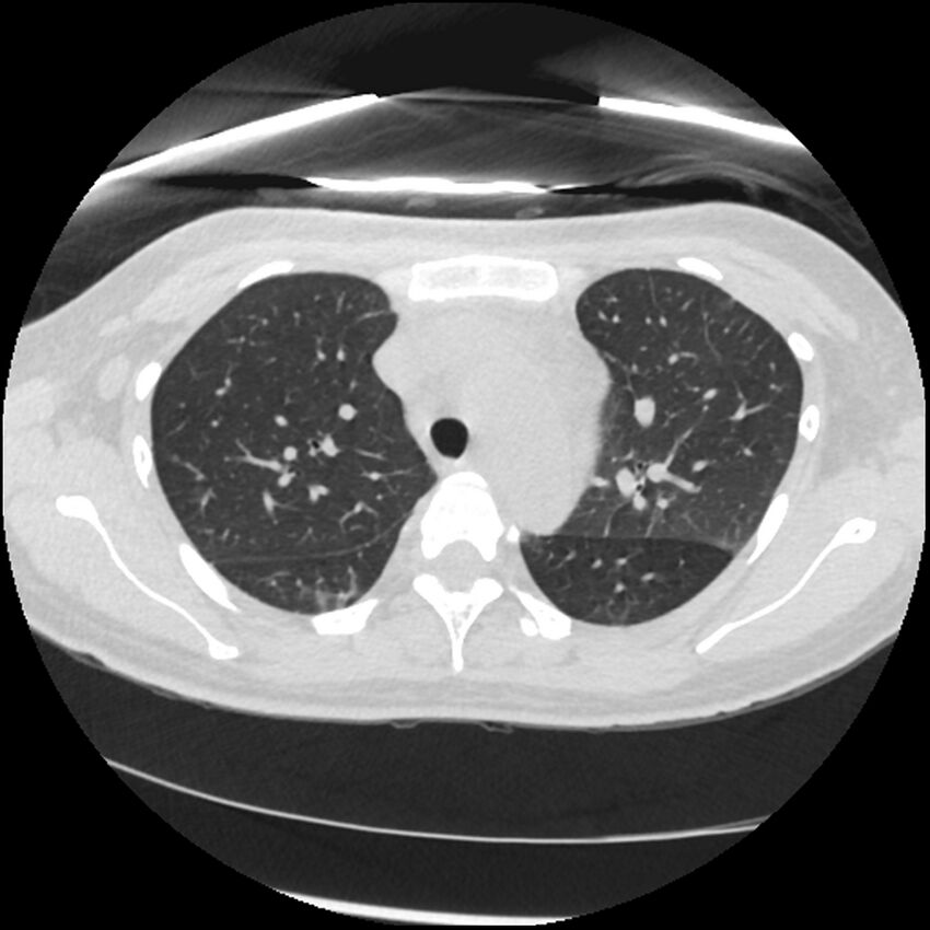 Acute lupus nephritis (Radiopaedia 45832-50107 Axial lung window 26).jpg