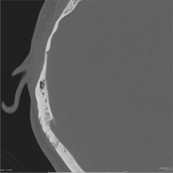 File:Acute otomastoiditis (Radiopaedia 28276-28512 Axial PTB bone window reformat 13).jpg