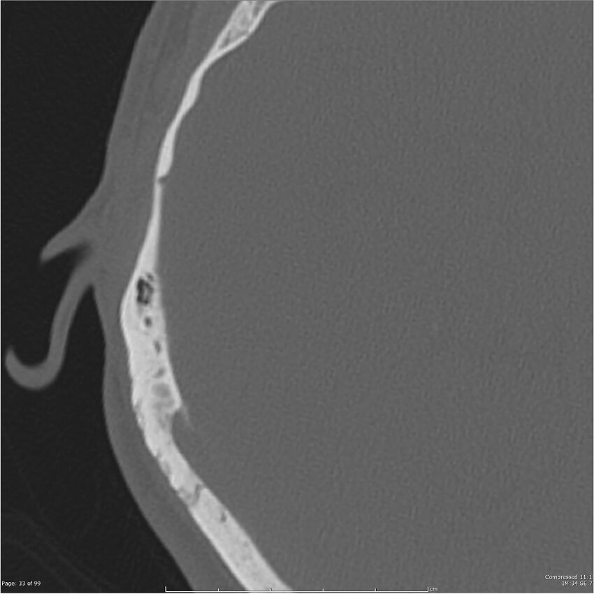 Acute otomastoiditis (Radiopaedia 28276-28512 Axial PTB bone window reformat 13).jpg