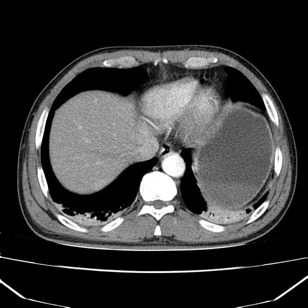 File:Acute pancreatitis (Radiopaedia 22572-22596 Axial C+ arterial phase 8).jpg
