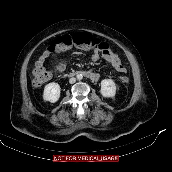 File:Acute pancreatitis with infected necrosis (Radiopaedia 26454-26585 Axial C+ delayed 20).jpg