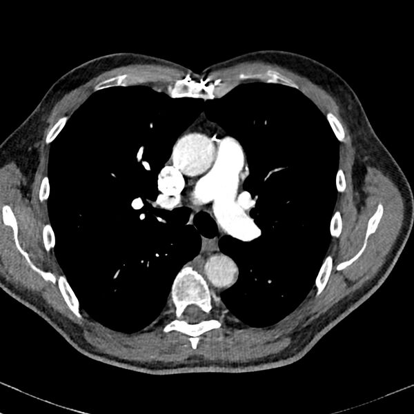 File:Acute pulmonary embolism (Radiopaedia 81677-95570 Axial C+ CTPA 35).jpg