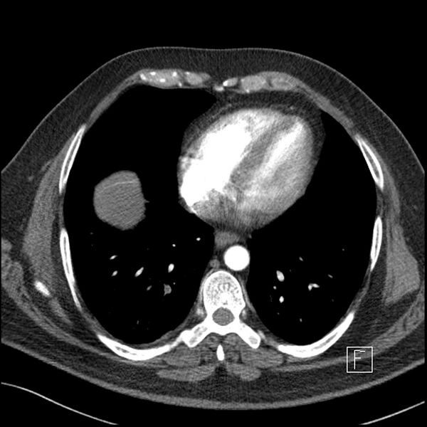 File:Acute pulmonary embolism with pulmonary infarct (Radiopaedia 73062-83768 Axial C+ CTPA 54).jpg