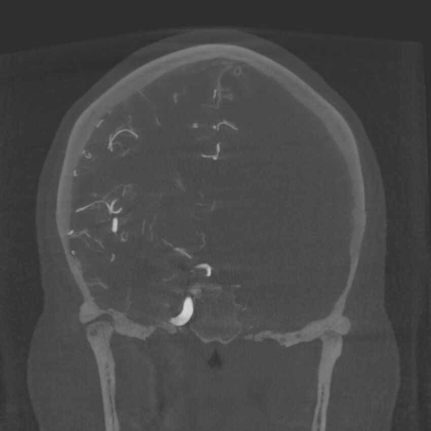 Acute subarachnoid hemorrhage and accessory anterior cerebral artery (Radiopaedia 69231-79010 Coronal arterial - MIP 51).jpg