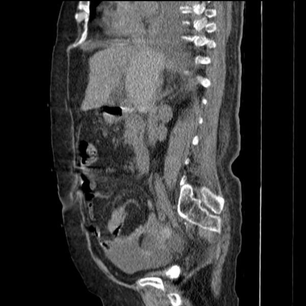 File:Acute tubular necrosis (Radiopaedia 28077-28334 H 39).jpg